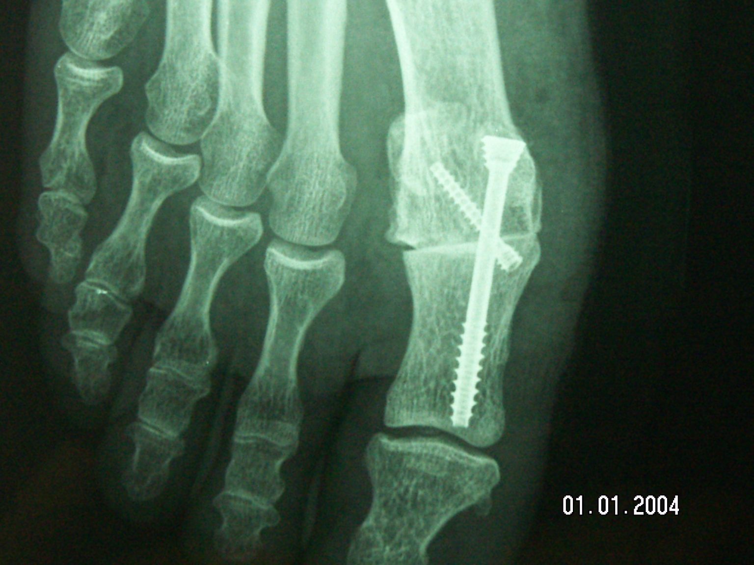 hallux rigidus ou arthrose métatarsophalangienne du gros orteil