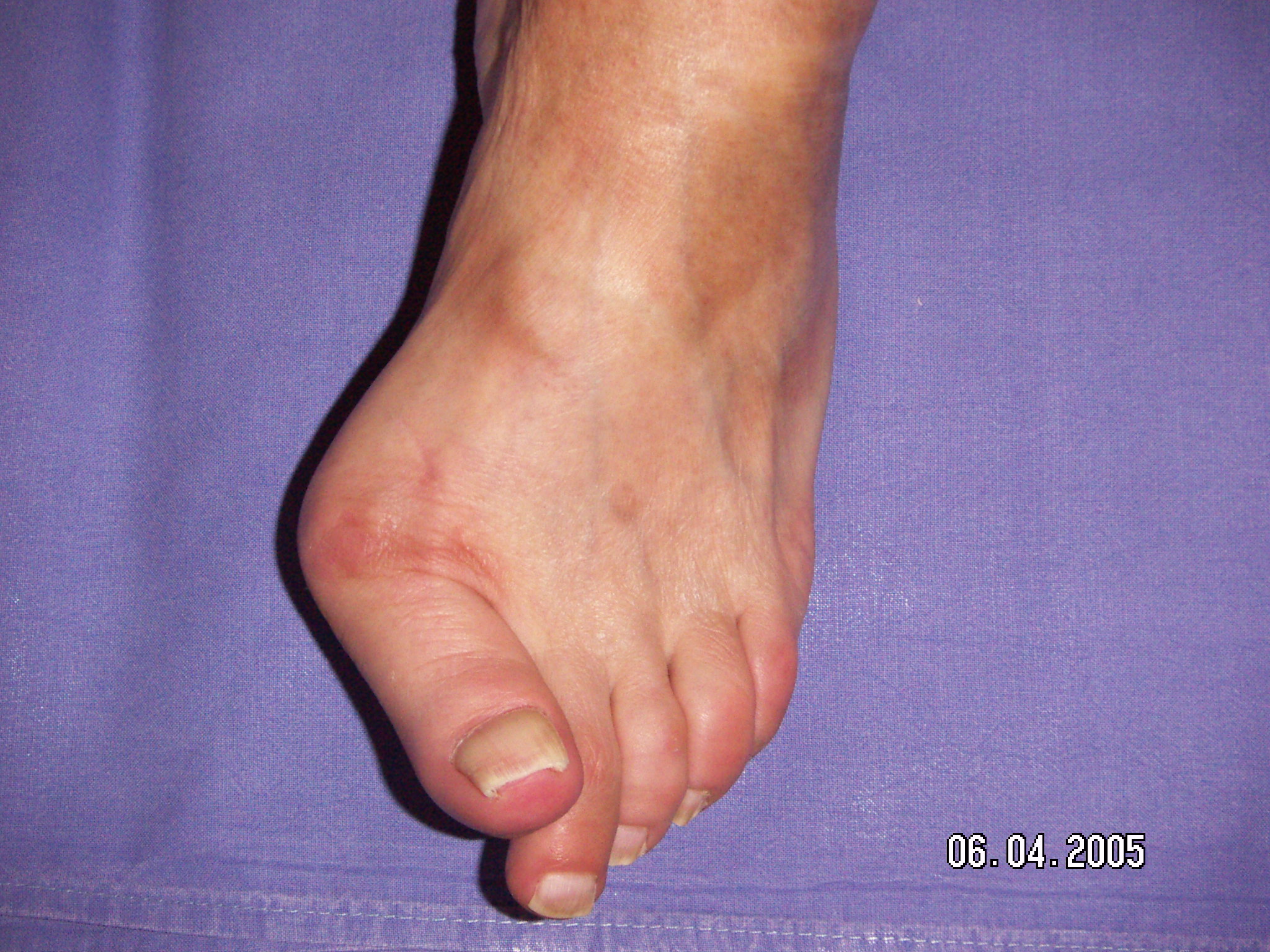 Hallux Valgus Ou Oignon D Formation Orteil Et Pied