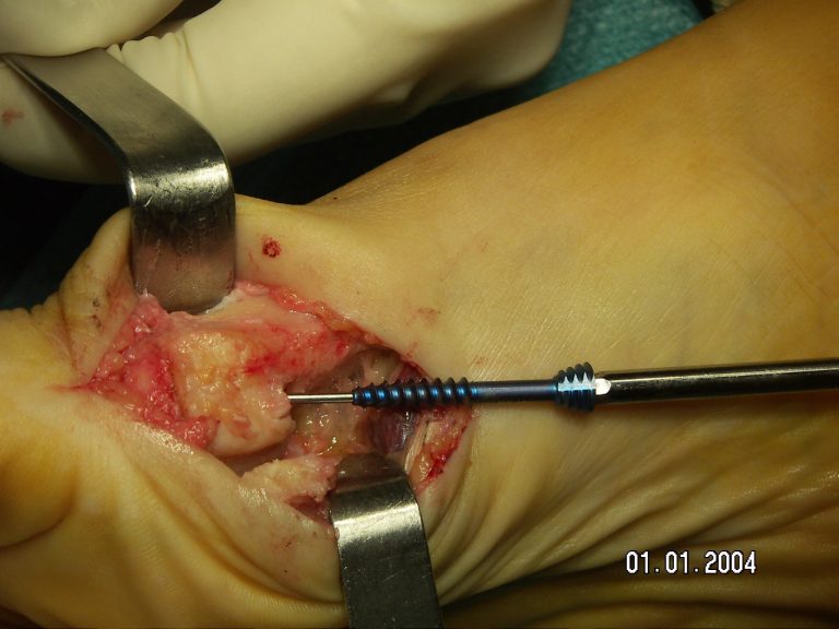 hallux rigidus ou arthrose métatarsophalangienne du gros orteil