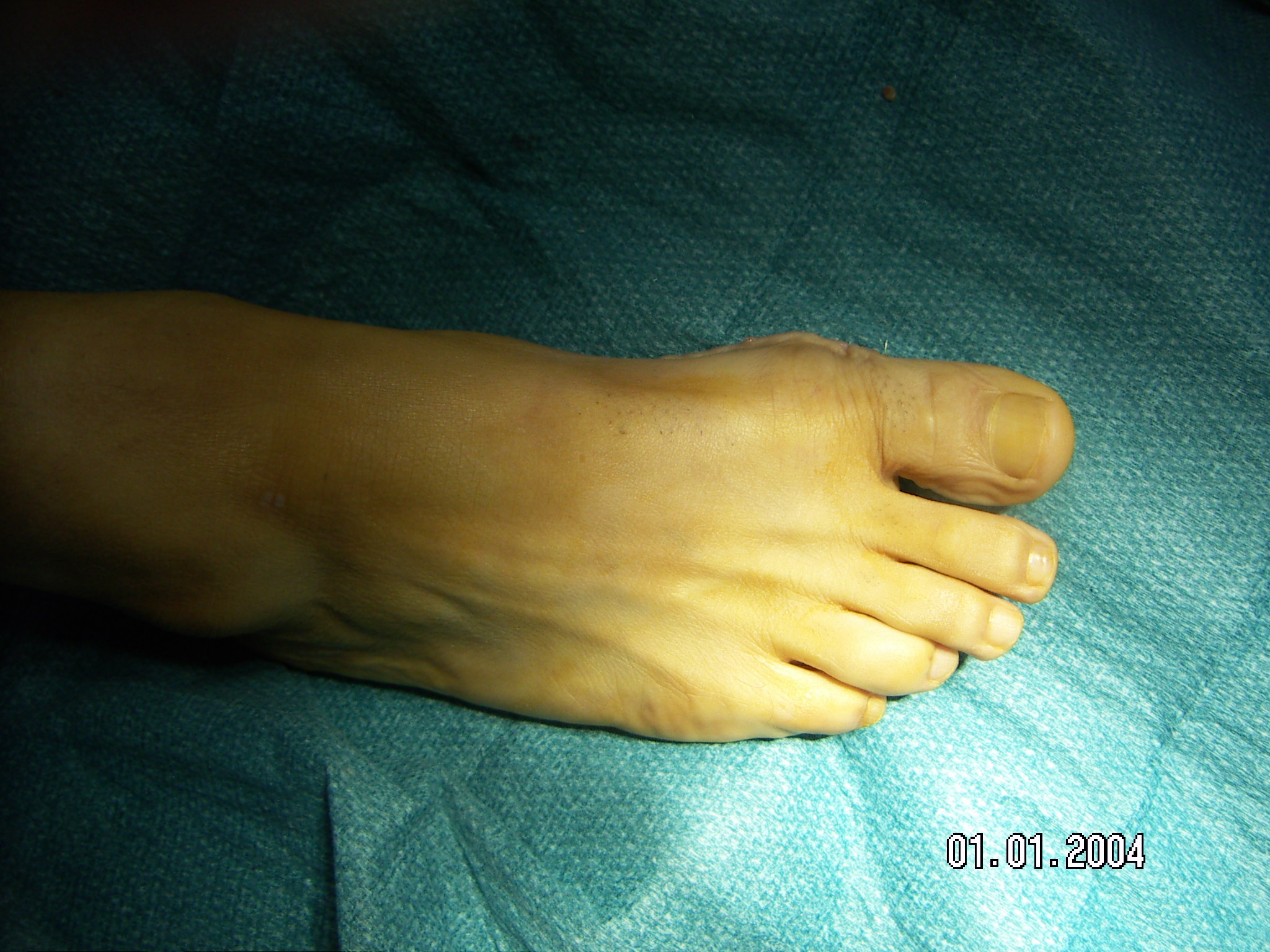 hallux rigidus ou arthrose métatarsophalangienne du gros orteil