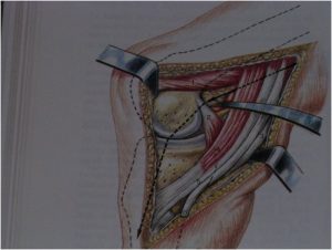 lca-Ligamentoplastie - Remplacement ligaments croisés antérieur ...