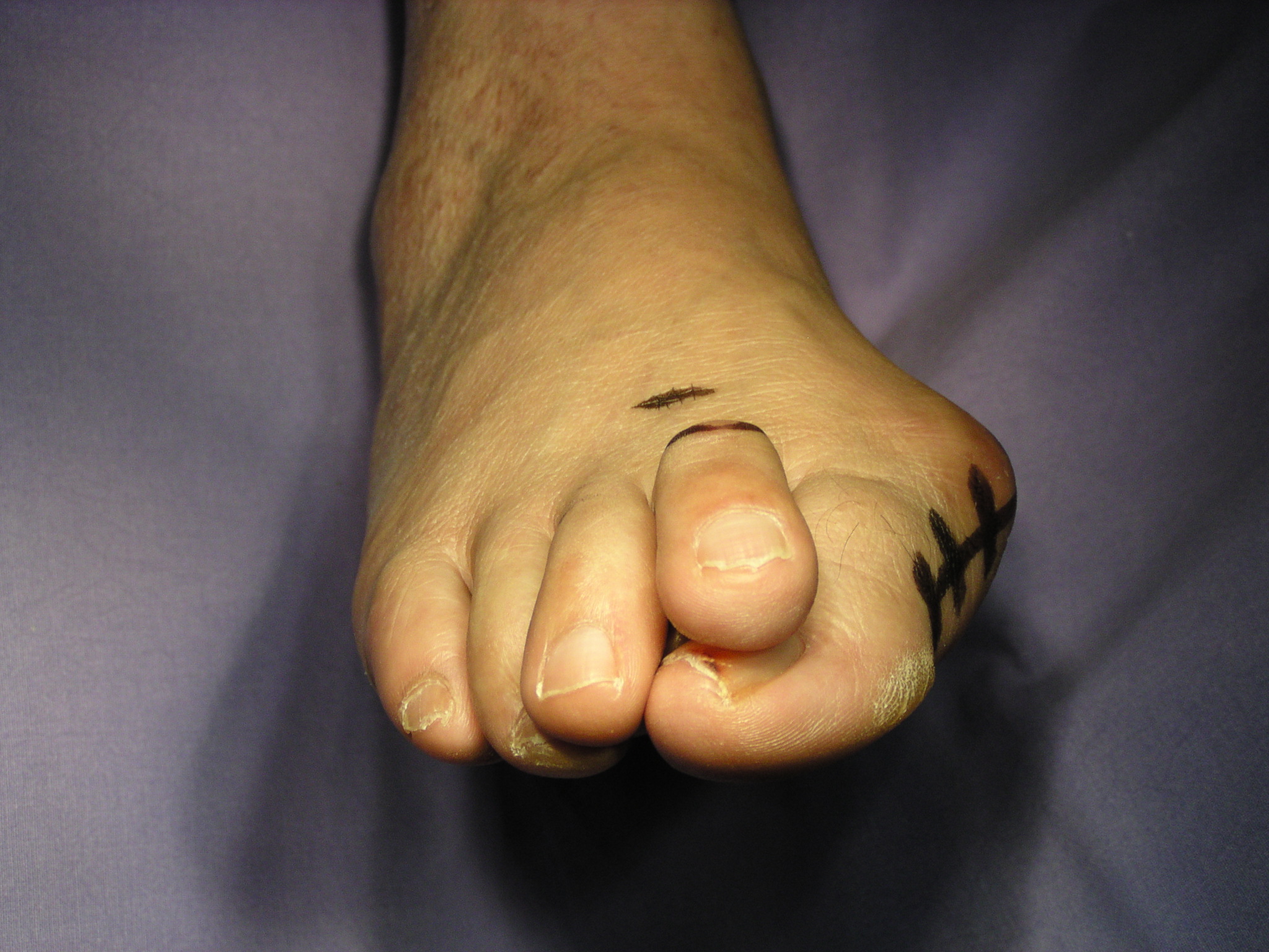 Hallux Valgus Ou Oignon D Formation Orteil Et Pied