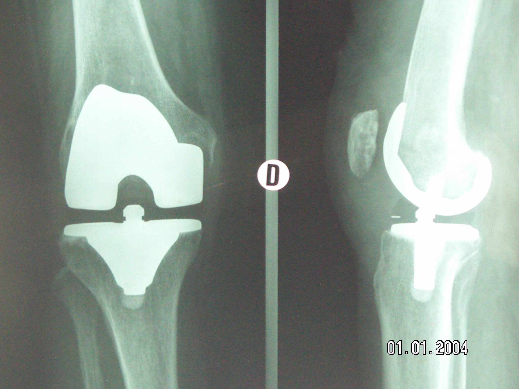 prothese de genou PTG ou PUC Chirurgie genoux Evry